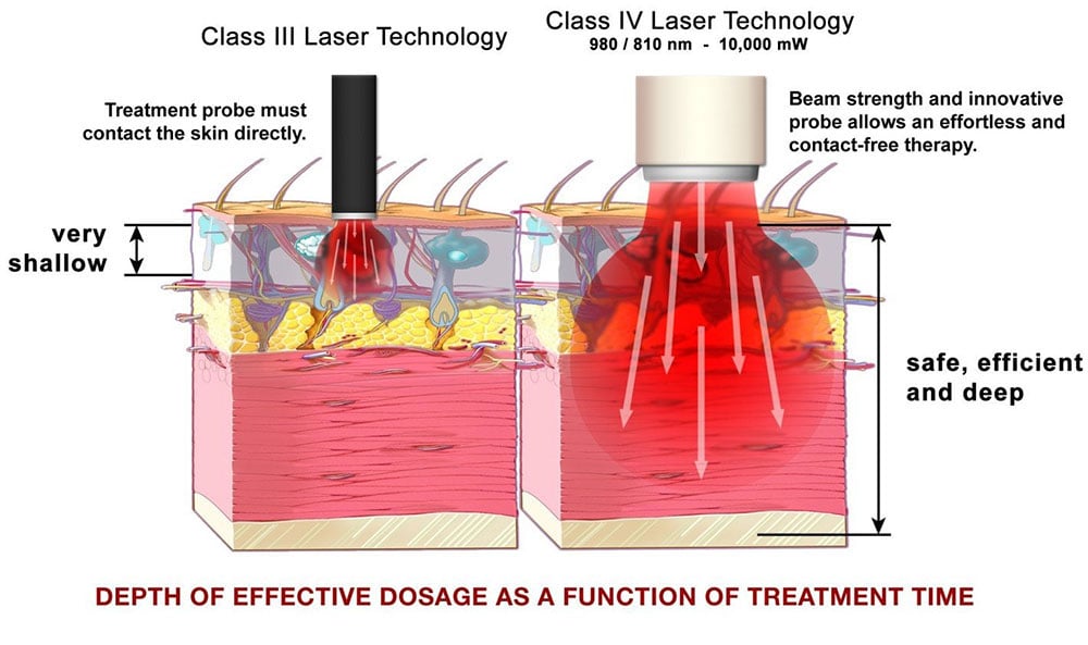 Class III Vs Class IV Therapy Laser