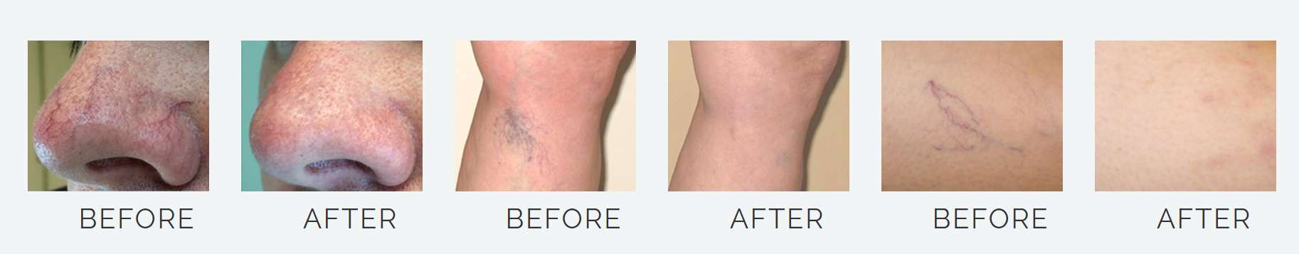 Laser Spider Vein Removal Before and After