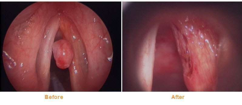 before after vocal cord polyp laser treatment