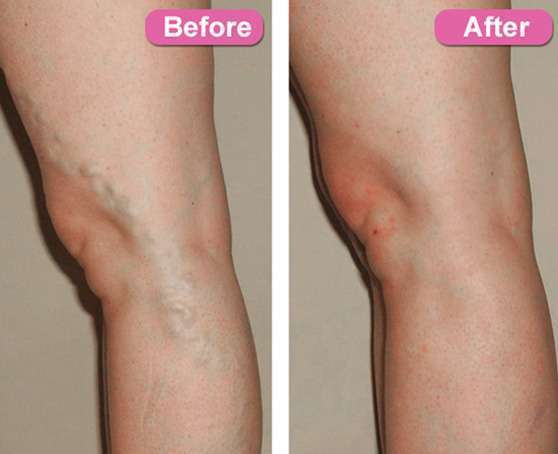 Endovenous Laser Ablation Treatment