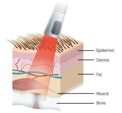 Equine Laser Therapy For Flexor Tendon Inflammation And Ligamentitis 