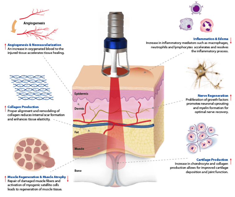 high power laser therapy principle