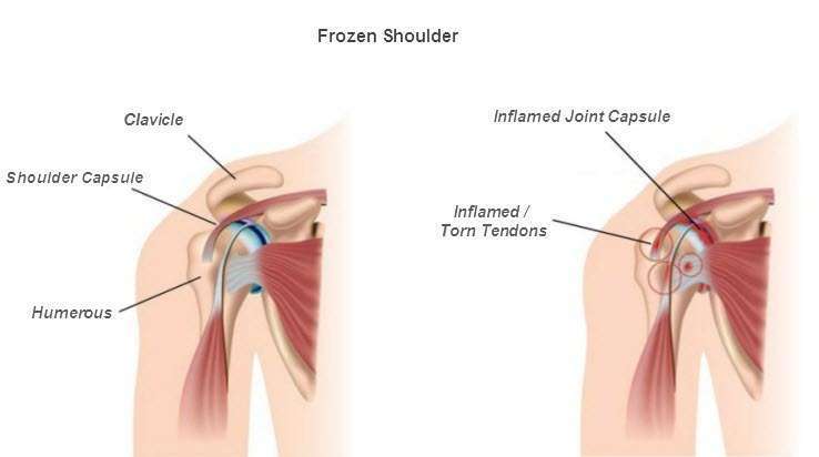 Laser Therapy For Shoulder Pain, Frozen Shoulder, Shoulder Tendonitis ...