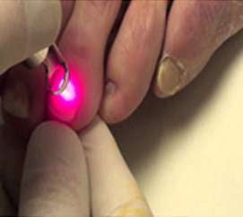 Laser Nail Fungus Laser Therapy