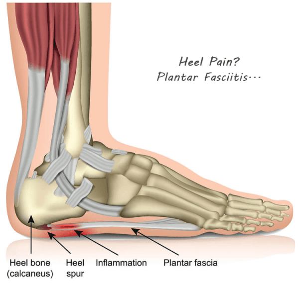 Laser For Plantar Fasciitis Treatment With Great Therapeutic Effect ...