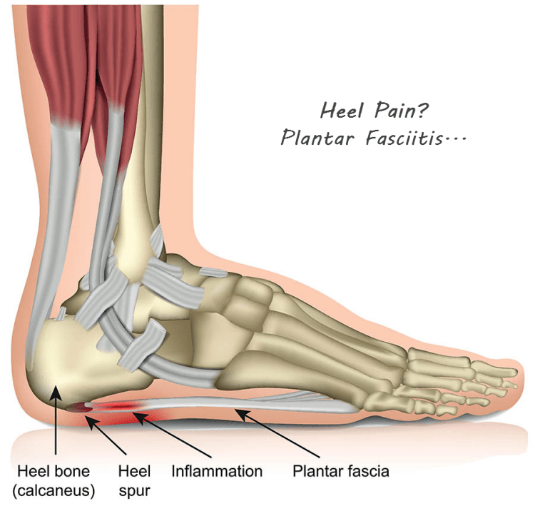 plantar fasciitis laser treatment