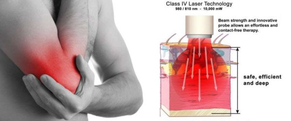 Laser Therapy For Tennis Elbow And Sports Injuries With Diode Laser ...