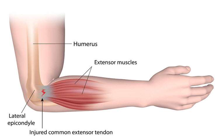 tennis elbow