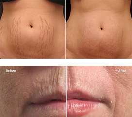 Laser Wrinkle Removal